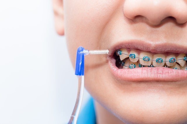 Financial Help for Braces for Kids' Teeth